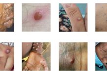 नेपालमा पहिलो पटक मंकीपक्सको संक्रमण भेटियो, अब के गर्ने?